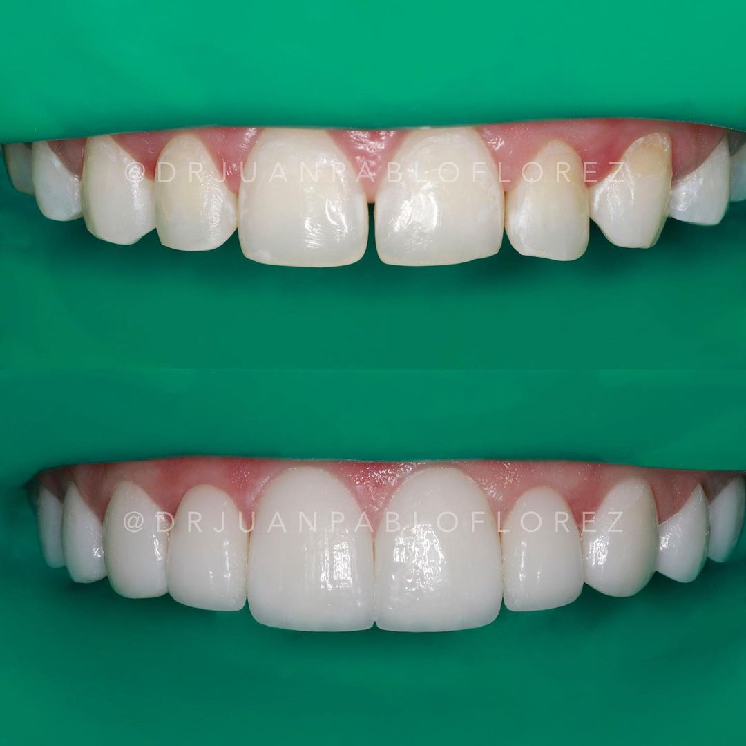 Antes y después con Armonia Oral Proceso- Diseño de sonrisa Laminados Cerámicos #laminadosceramicos #diseñodesonrisa #armoniaoral #sonrisa #antesydespues #odontologia #clinicaodontologica #bucaramanga